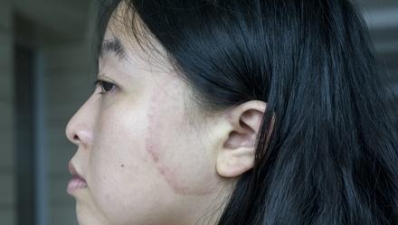 明星烫伤脸怎么处理,明星烫伤脸部急救与康复指南