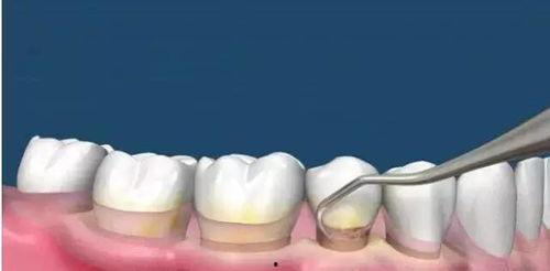 洗牙过程视频大全,视频大全带你直观体验